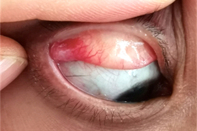 泪腺脱垂上眼皮里面有肿块图