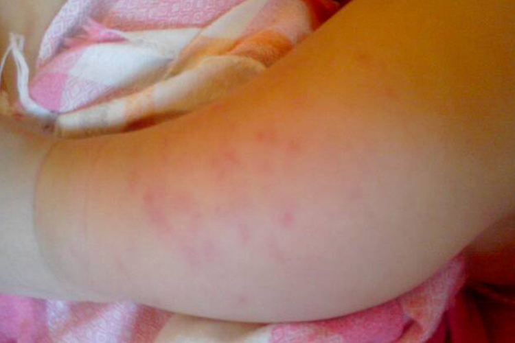 宝宝腿上起幼儿急疹图 宝宝腿上起幼儿急疹图