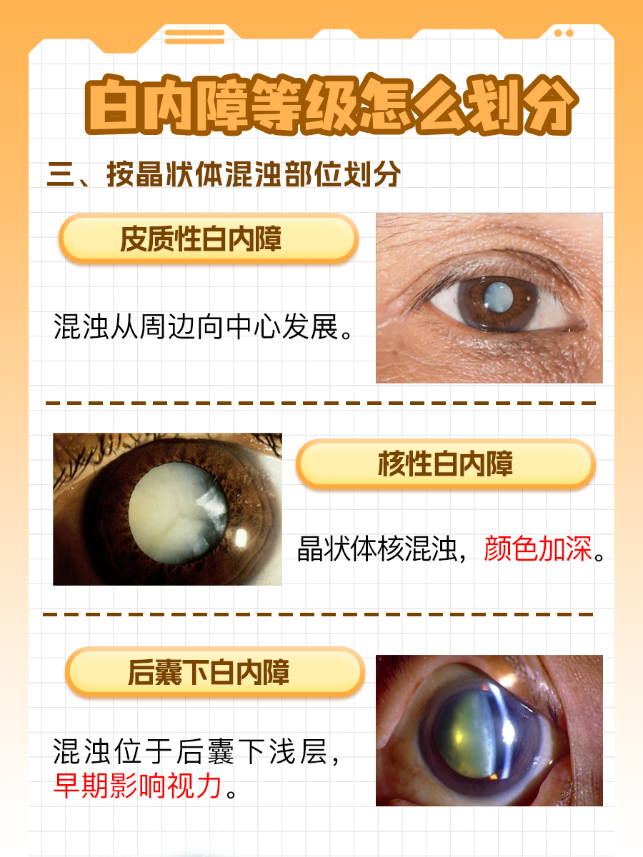 白内障等级划分：科普解析