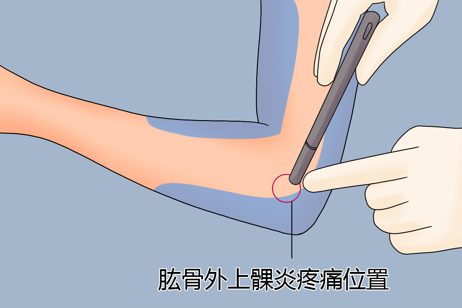 肱骨外上髁炎疼痛位置图