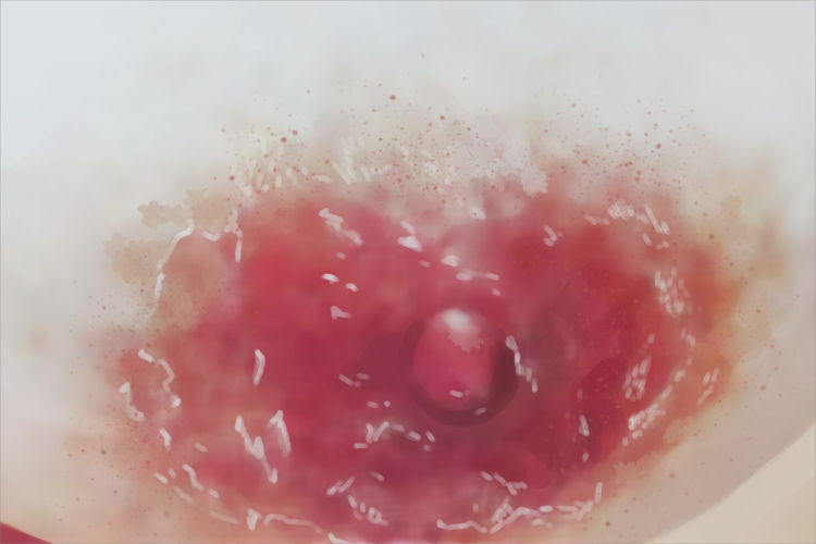 乳房Paget病糜烂图