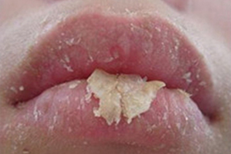 腺性唇炎嘴唇脱皮图