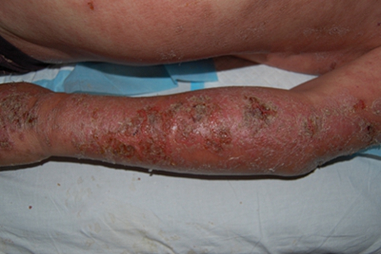 急性湿疹胳膊脱皮图