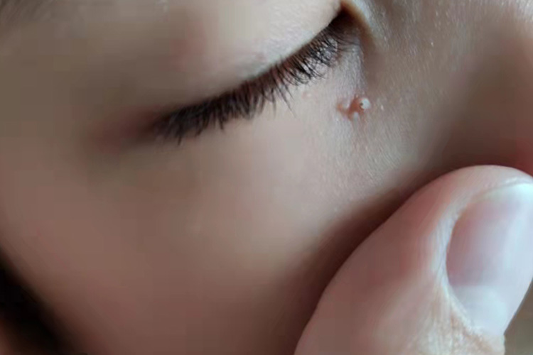 传染性软疣小米粒疙瘩图