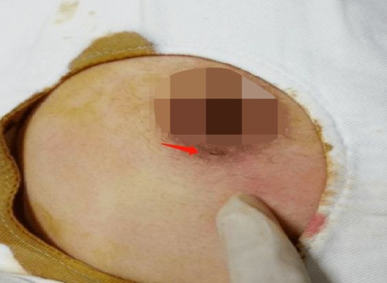 乳腺纤维瘤特征图片