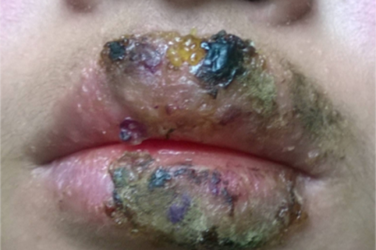 坏死性溃疡性龈口炎嘴唇症状图 坏死性溃疡性龈口炎嘴唇症状图