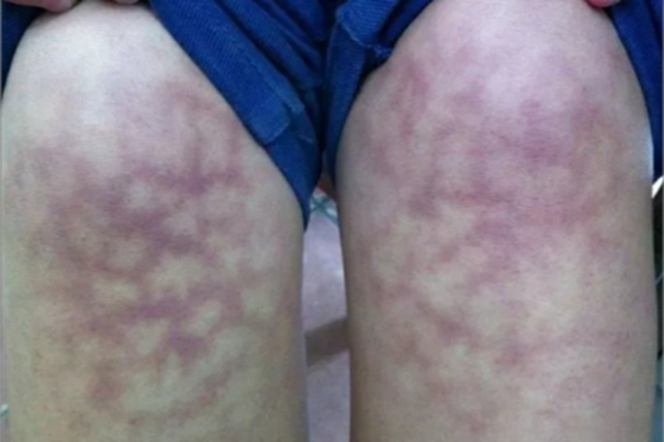 热激红斑腿部红斑图