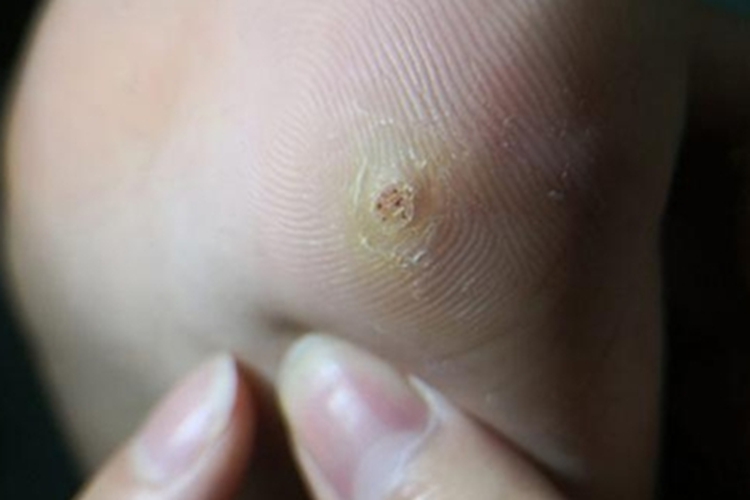 硬鸡眼脚底疙瘩图 硬鸡眼脚底疙瘩图