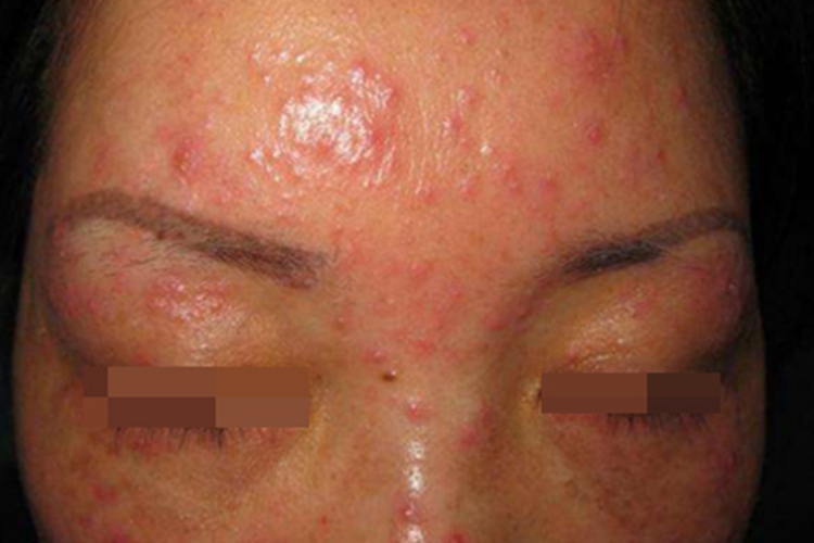 颜面粟粒性狼疮丘疹图