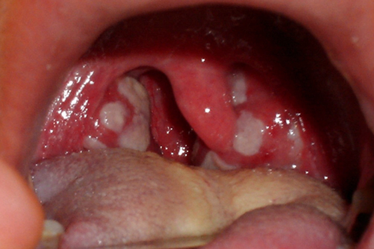 猩红热扁桃体旁有溃疡图