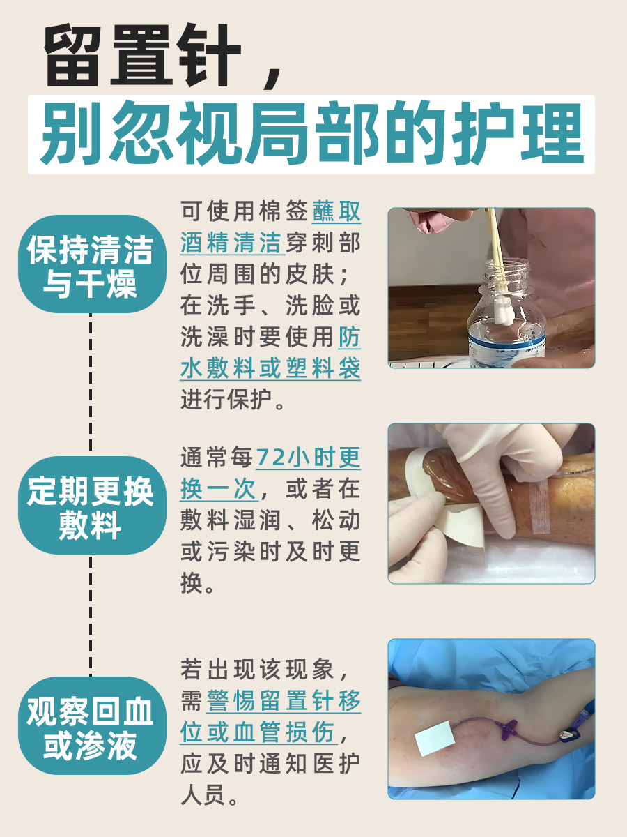 留置针使用期限：究竟能挺多久？