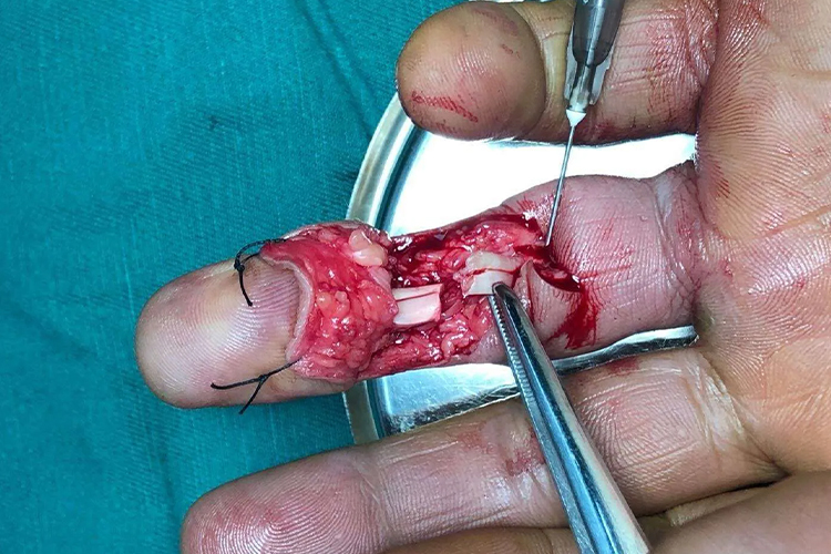 手指屈指肌腱断裂图