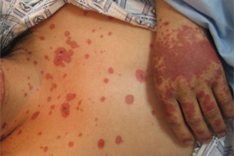重型多形红斑型药疹前胸症状图