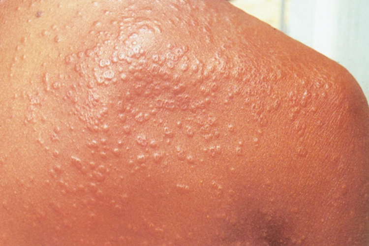 肩部环状肉芽肿图