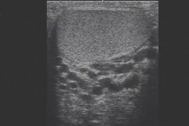 精索静脉曲张超声图