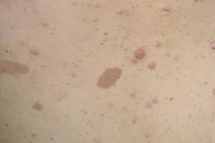 神经纤维瘤牛奶咖啡斑和雀斑图 神经纤维瘤牛奶咖啡斑和雀斑图