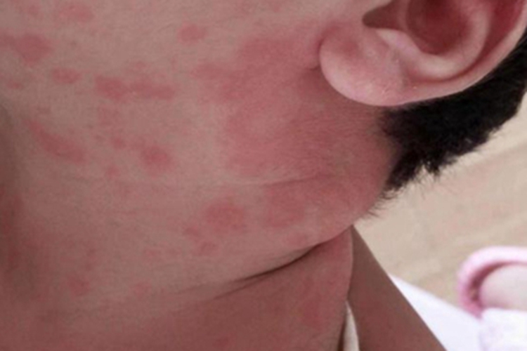 海鲜过敏颈部症状图 海鲜过敏颈部症状图