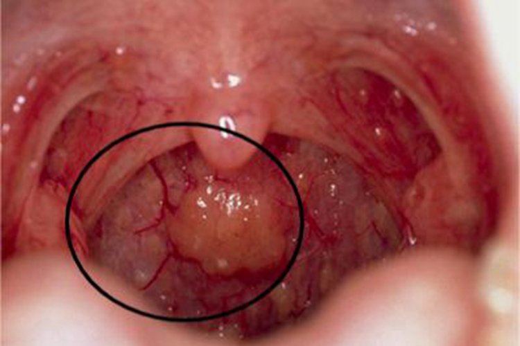 慢性咽炎咽喉血丝图