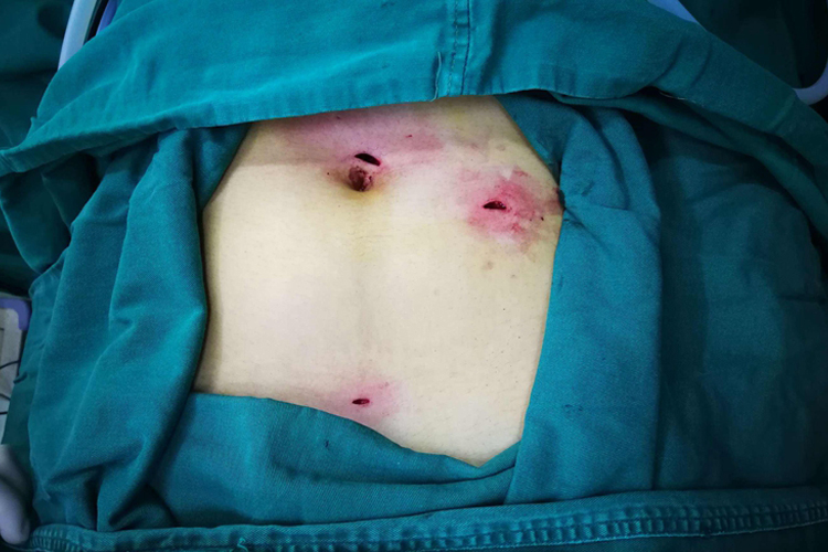 腹腔镜阑尾切除术伤口图