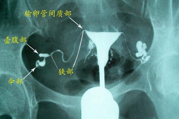 输卵管位置图 输卵管位置图