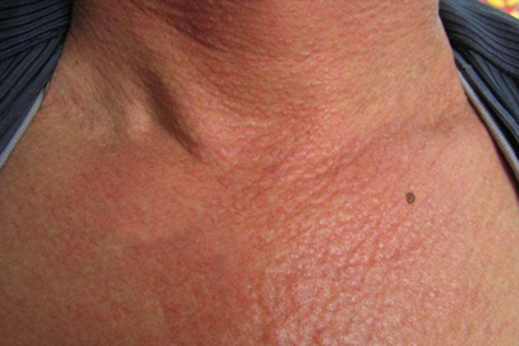 结节性类弹性纤维病前颈疙瘩图 结节性类弹性纤维病前颈疙瘩图