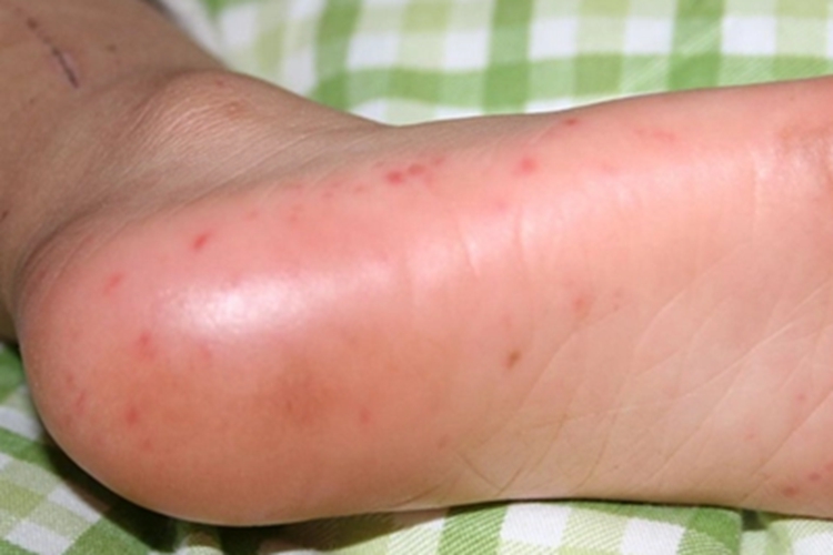 手足口病脚底红点图