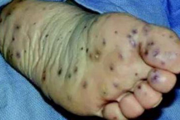 蓝色橡皮疱样痣脚底症状图