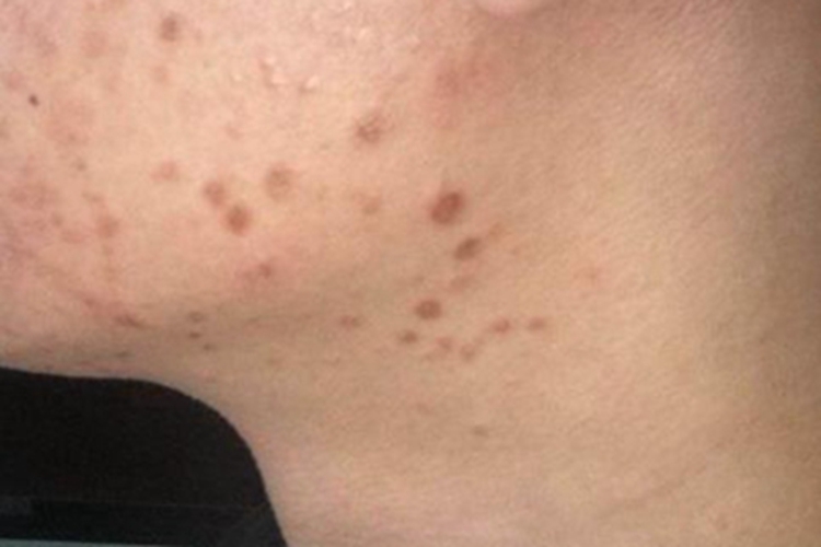 扁平疣颈部斑图