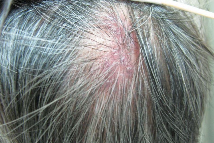 单纯疱疹头部红斑图