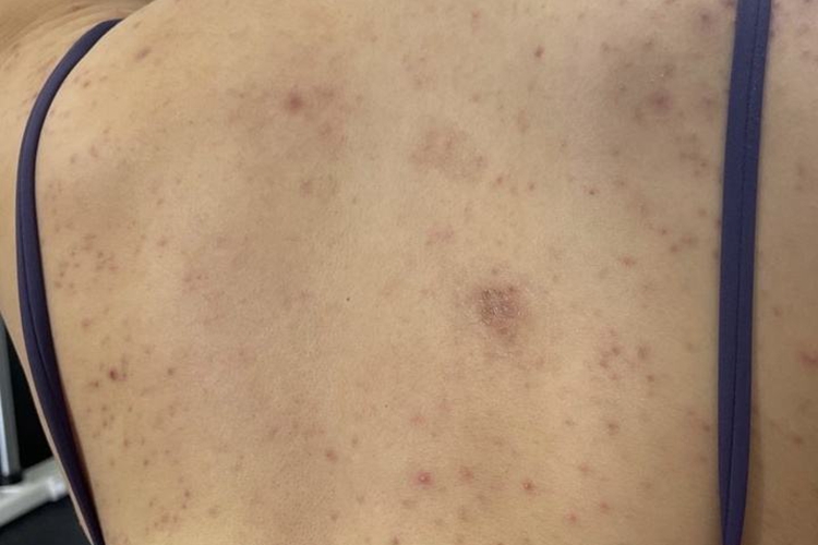 马拉色菌毛囊炎结痂脱落图