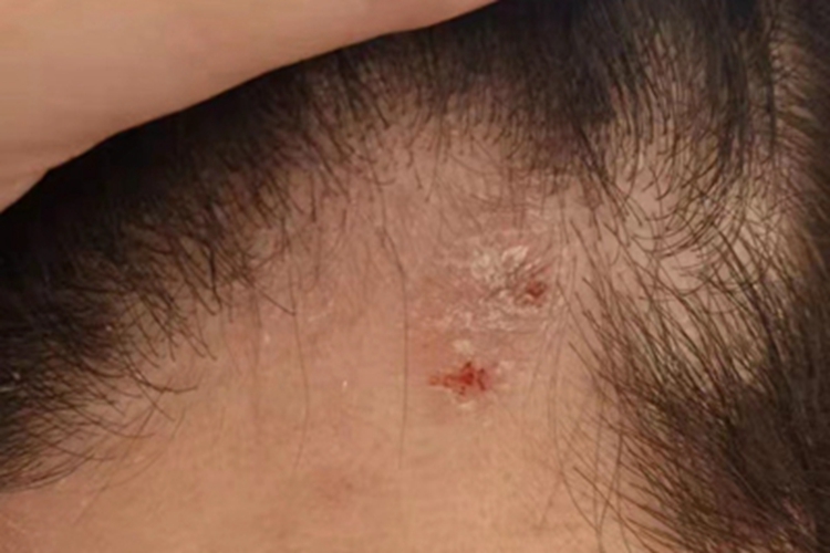 寻常型银屑病前额疙瘩图