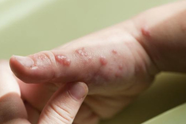 种痘样水疱病手部症状图