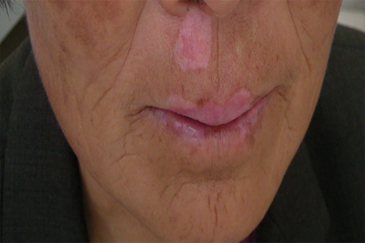 白癜风早期白斑图