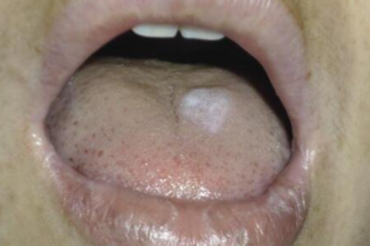 斑块型口腔扁平苔藓舌头症状图