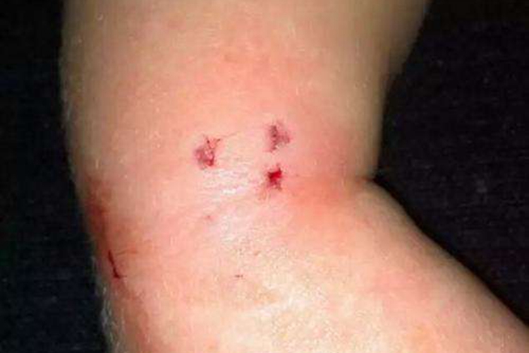 老鼠咬人轻微伤口图 老鼠咬人轻微伤口图