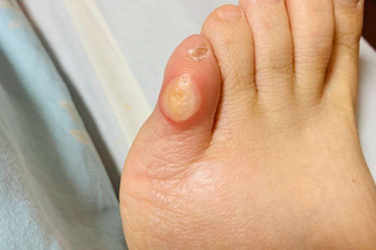 浸渍足脚趾症状图