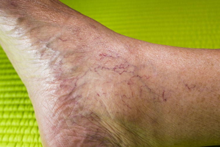 下肢静脉曲张水肿图