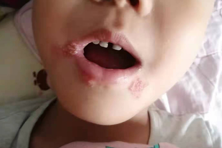原发性疱疹性口炎糜烂期图