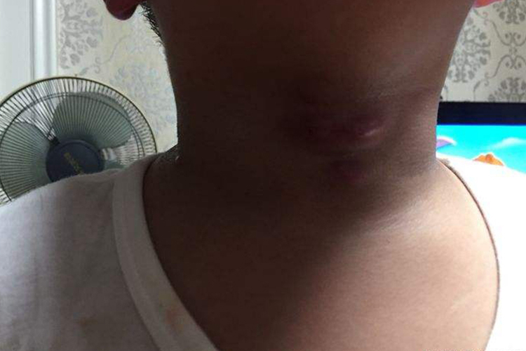 小孩脖子皮脂腺囊肿图 小孩脖子皮脂腺囊肿图