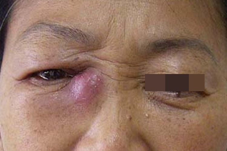 急性泪囊炎图 急性泪囊炎图