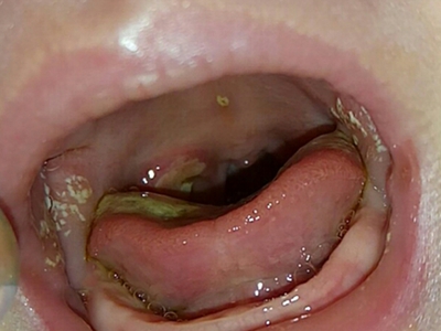 宝宝口舌生疮症状图片图片
