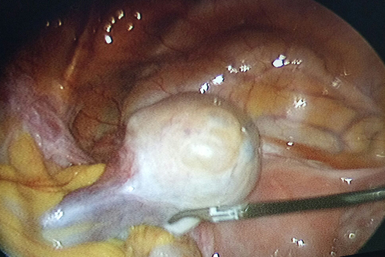 卵巢良性肿瘤图