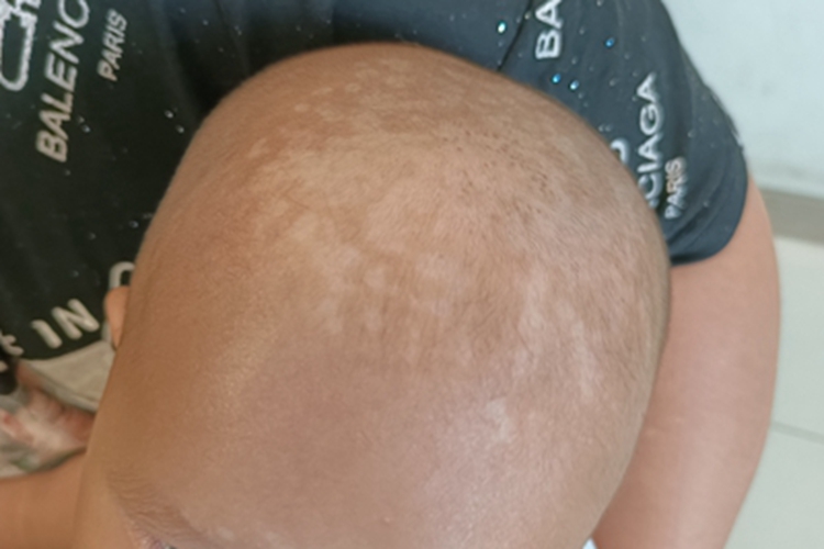 花斑糠疹头皮白斑图