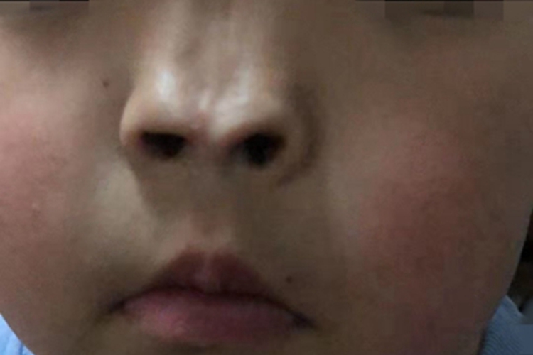 鼻裂鼻尖变形图