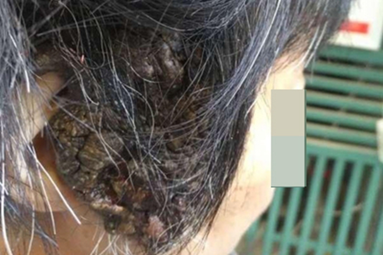 先天性巨痣耳前结节图