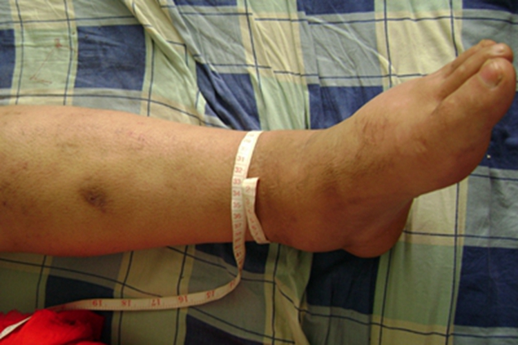 淋巴丝虫病脚部肿图 淋巴丝虫病脚部肿图