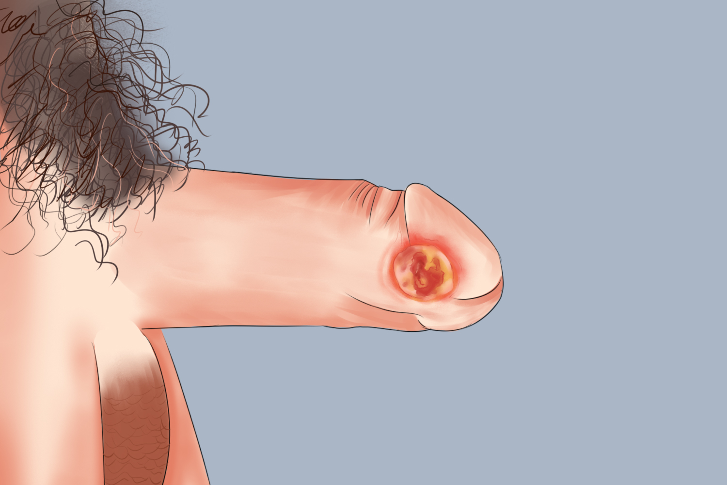 男性硬下疳溃疡图