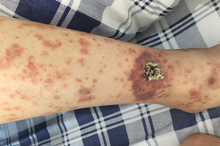 糖尿病胫前色素斑图