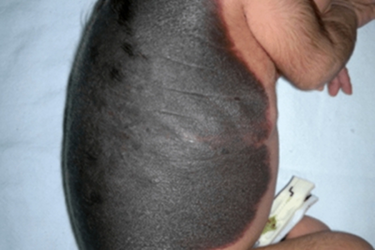 兽皮痣背部毛发过长图