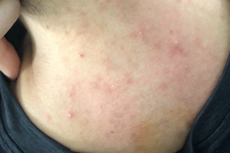 细菌性毛囊炎后颈丘疹图 细菌性毛囊炎后颈丘疹图